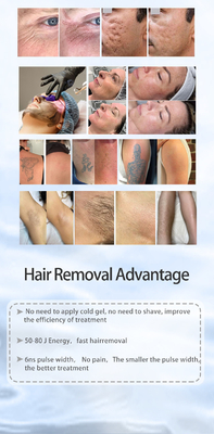 Tất cả trong một Picosecond Laser loại bỏ lông và ND YAG Laser loại bỏ hình xăm máy