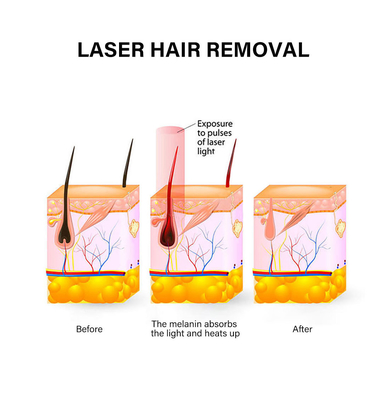 Thiết bị loại bỏ lông laser di động 810nm Máy loại bỏ lông vĩnh viễn cho phụ nữ
