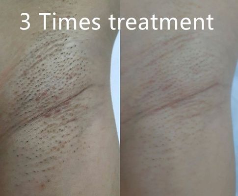 Thiết bị triệt lông bằng laser diode đa chức năng hỗ trợ các độ rộng xung khác nhau để giảm lông vĩnh viễn theo yêu cầu