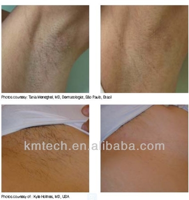 Máy loại bỏ lông bằng laser chuyên nghiệp