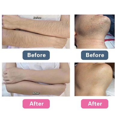 Máy làm trẻ khuôn mặt bằng laser picosecond, Máy loại bỏ hình xăm chuyển đổi Q