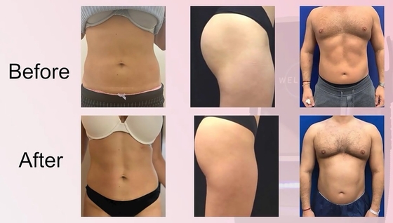 Máy giảm cân máy tính EMS chuyên nghiệp máy cellulite cho chăm sóc da