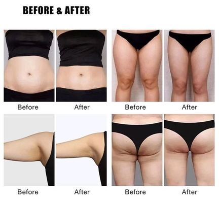 Máy đốt mỡ RF EMS, Máy đốt mỡ EMS
