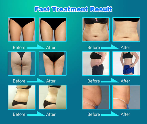 Máy massage cuộn chân không đứng 3500W Máy loại bỏ cellulite cơ thể