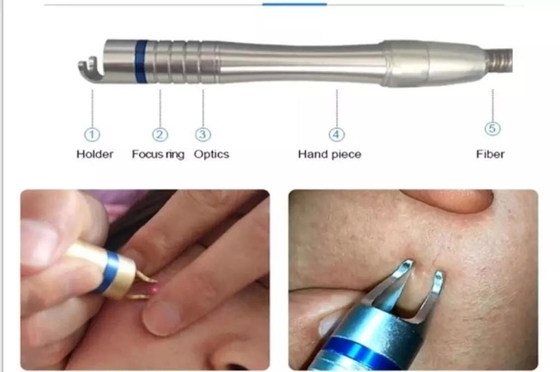 Máy loại bỏ mạch máu bằng laser 15W 30W để điều trị móng chân / Tái trẻ hóa da bằng laser nóng