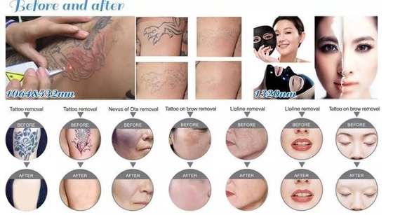 Máy loại bỏ hình xăm laser Nd YAG di động 1064nm 532nm 1320nm