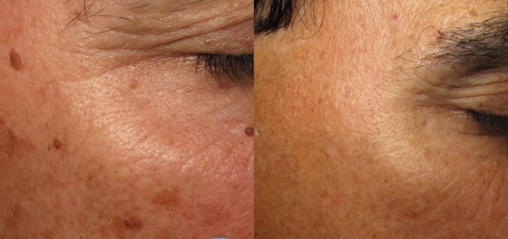 Máy làm đẹp bằng laser y tế Nd YAG cho giảm cân / làm chặt da