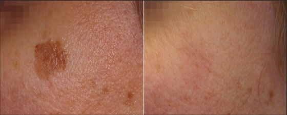 Máy làm đẹp bằng laser y tế Nd YAG cho giảm cân / làm chặt da