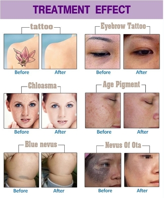 Máy cắt tóc bằng laser ND YAG Long Pulse