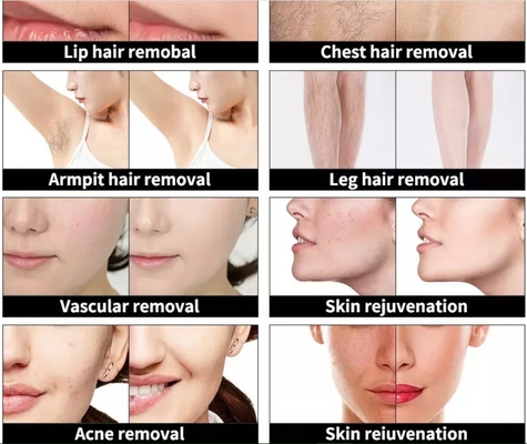 4 trong 1 Máy làm đẹp đa chức năng Máy loại bỏ hình xăm bằng laser ba bước sóng