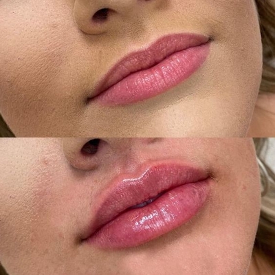 4 trong 1 Máy làm đẹp đa chức năng Máy loại bỏ hình xăm bằng laser ba bước sóng