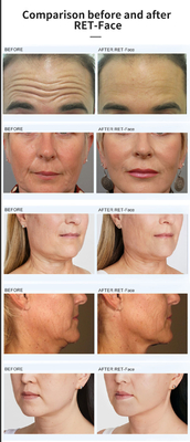 Đường thẳng Magnetic Face Ems rf Khôi phục da nâng da thắt da giảm cân Rf nâng máy