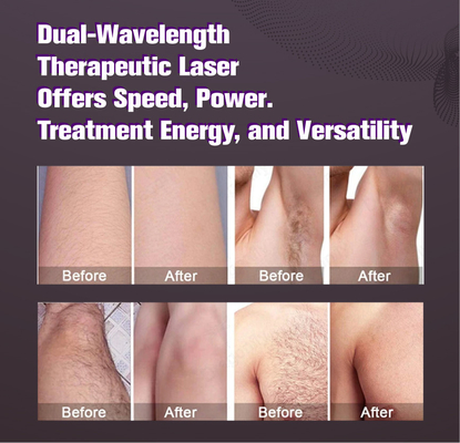 Đèn laser kích thước nến lớn alexandrite loại bỏ lông trắng REMOVAL 2000w alexandrite thiết bị laser