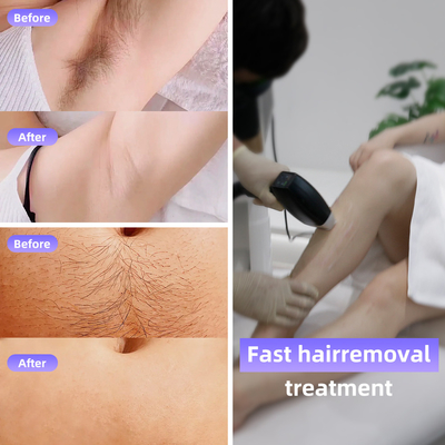 808 Diode Laser Ice Hair Removal Machine 4 Wavelengths 1064nm Định dạng điểm thay đổi